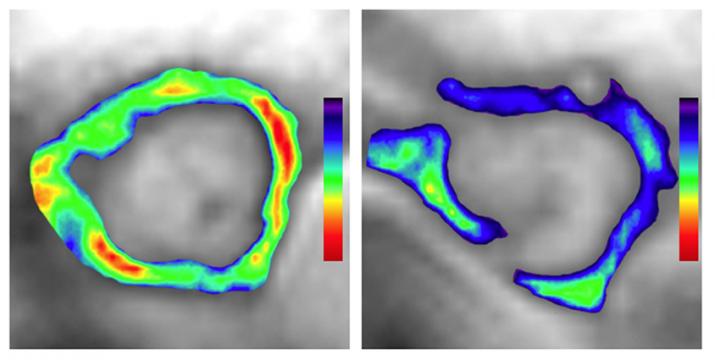 atherosclerosis in a mouse artery